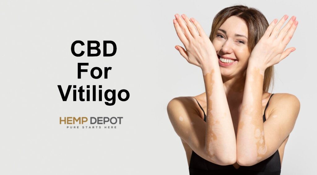 CBD For Vitiligo